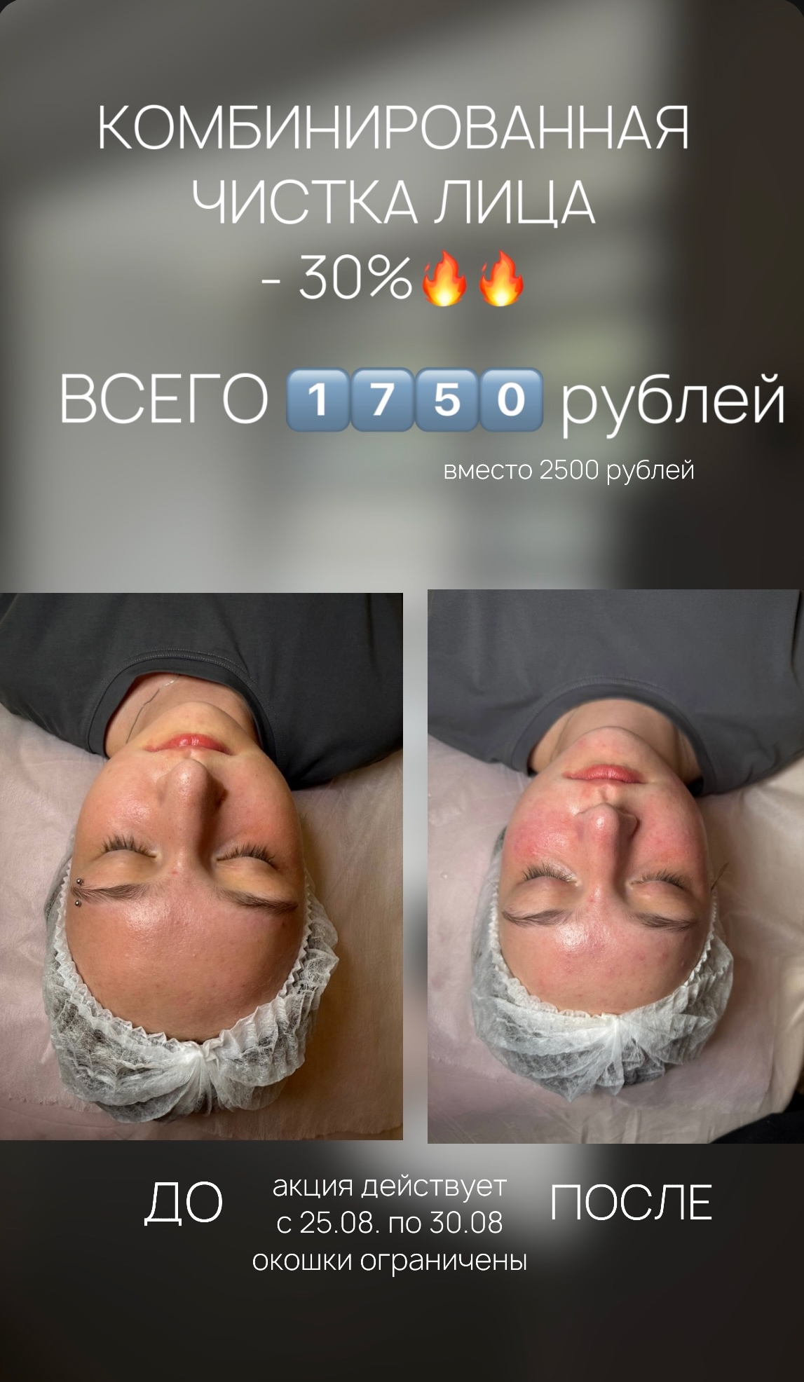 Комбинированная чистка лица